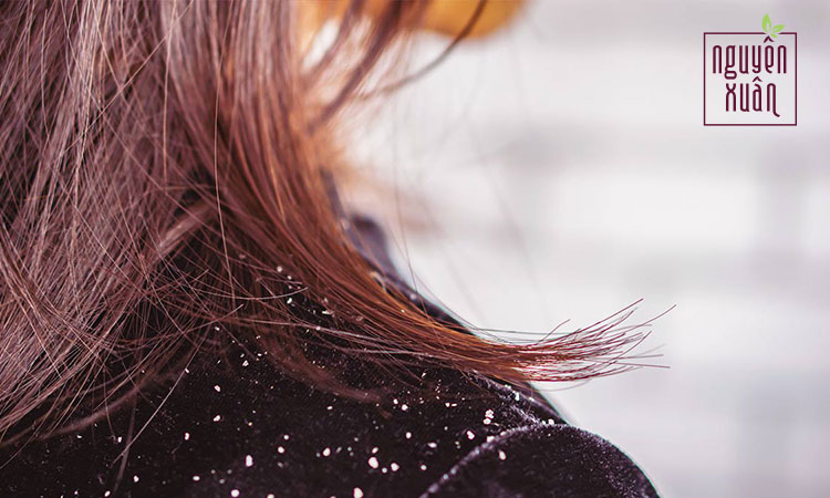 Đầu sạch gầu chỉ với 5 K  aspirin